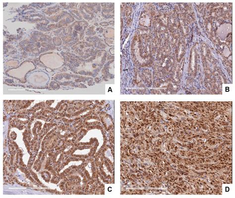 Differentiating Thyroid Follicular Adenoma from Follicular Carcinoma ...