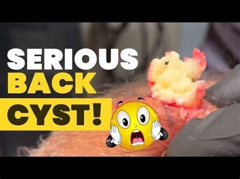 Image result for Explosive Back Cysts