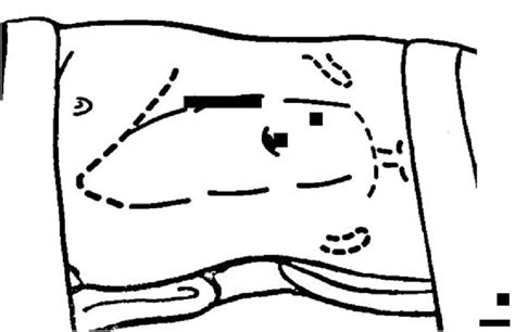 Image result for Flank Incision Nephrectomy