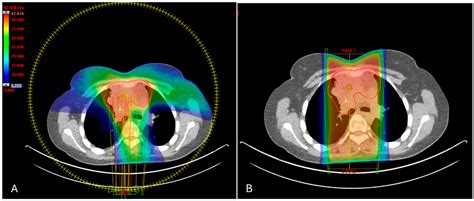 Minimizing Long-Term Toxicities for Patients with Primary Mediastinal B-Cell Lymphoma Undergoing ...