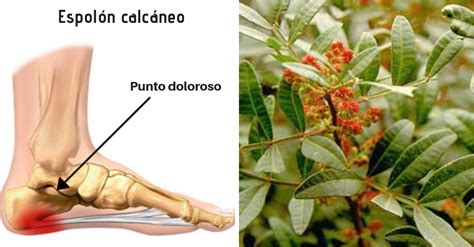 Aprenda un tratamiento para el espolón calcáneo con una receta casera