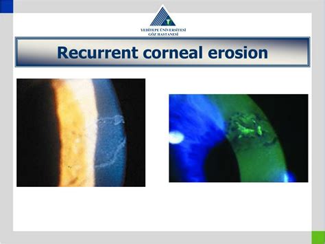 Recurrent Corneal Erosion