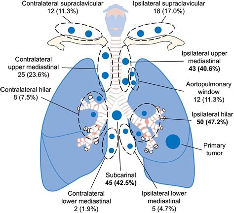 Regional lymph node recurrence after stereotactic body radiation therapy for lung cancer ...