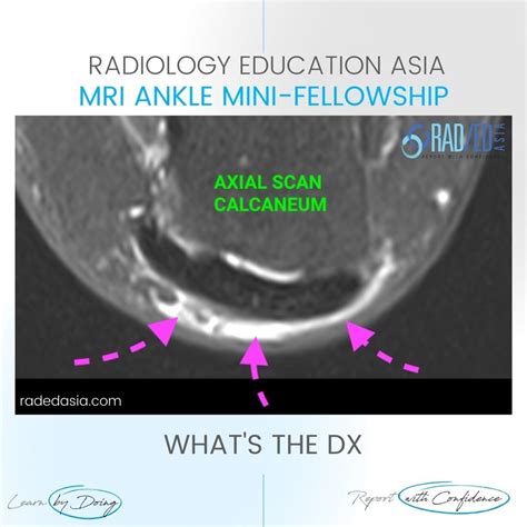 RETROACHILLES BURSA BURSITIS MRI RADIOLOGY ANKLE - Radedasia