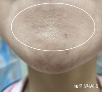 【图】女性嘴角起痘痘什么原因 没想到是这些造成的_嘴角_伊秀美容网|yxlady.com