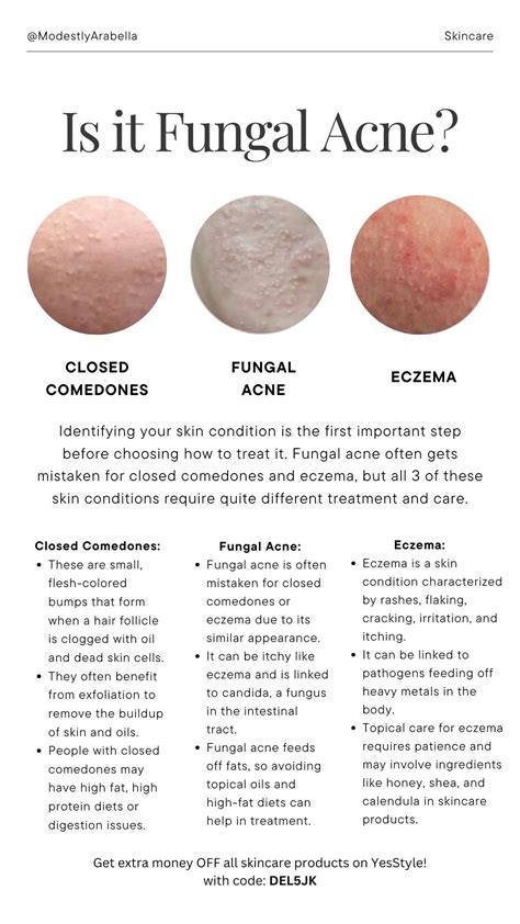 What Is Fungal Acne