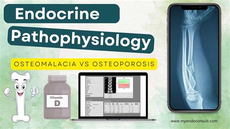 Osteomalacia Vs Osteoporosis : Know The Difference - My Endo Consult