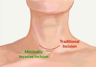 PARATHYROIDECTOMY - With Local Anesthesia - parathyroid