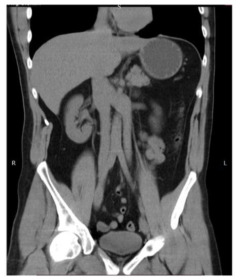Paraaortic Lymphadenectomy in Gynecologic Oncology—Significance of ...