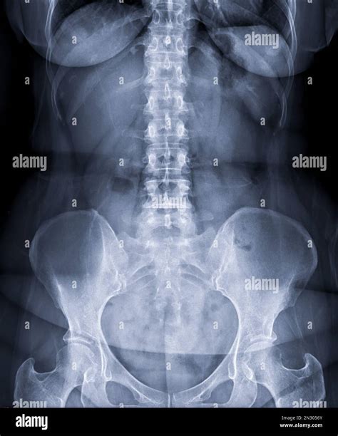 X-ray image of lumbar Spine or L-s spine front view for diagnosis lower back pain Stock Photo ...