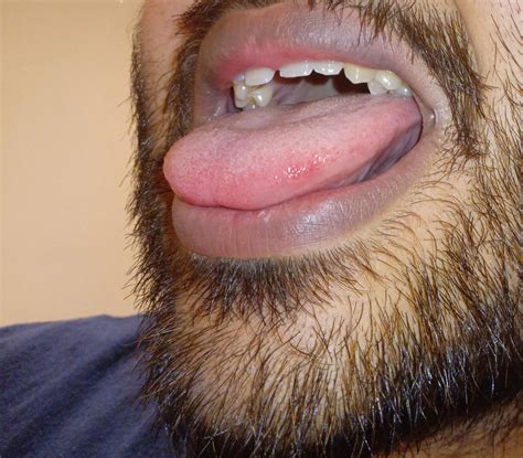 what are these red bumps on side of tongue? : r/askdentists