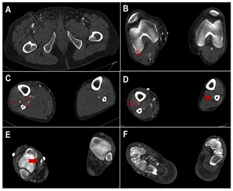 Conversion of Femoral-Tibial Bypass Surgery into Deep Vein ...