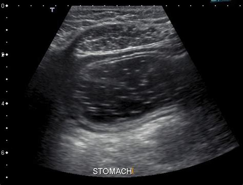 Abnormal Abdominal Ultrasound