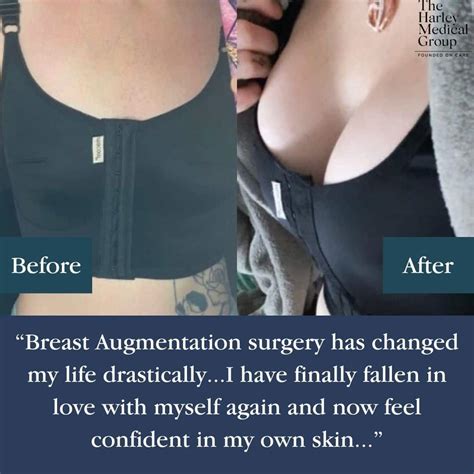 Breast Augmentation Before And After High Profile
