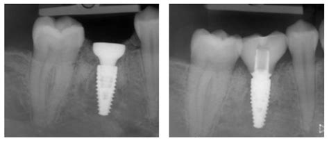 Immediate versus Delayed Implant Placement in Patients with Tooth ...