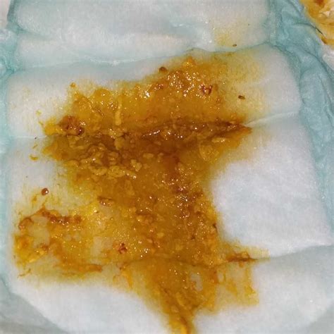 Blood In Stool Babies | Renew Physical Therapy