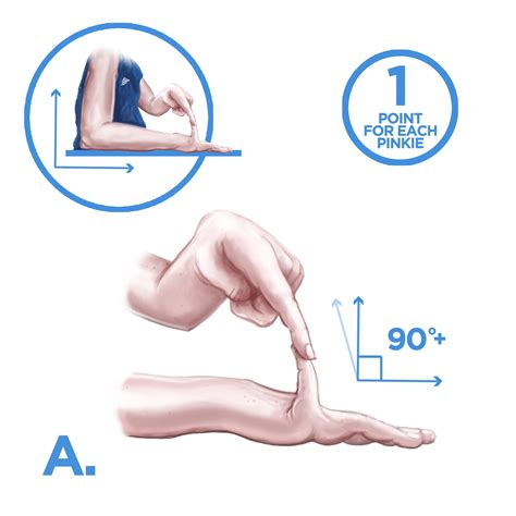 Assessing Joint Hypermobility - The Ehlers Danlos Society