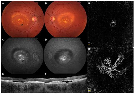 The Role of Optical Coherence Tomography Angiography (OCTA) in ...