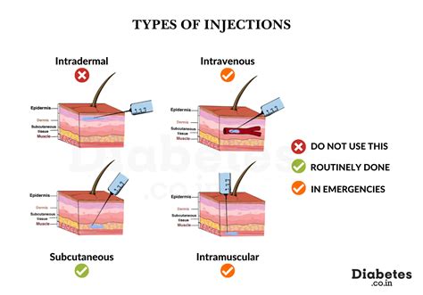 Are Insulin Injections Subcutaneous or Intramuscular?
