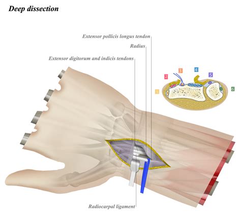 First Dorsal Compartment Release Surgery at James Kettler blog