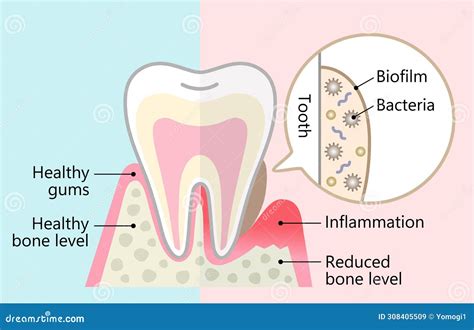 Dental Biofilm Removal Cute Character Illustration. Bacteria And Plaque Attachment On Tooth ...