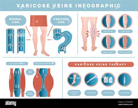 Varicose infographic. Venous disease medical health problems with human blood venous recent ... - treat venous disease