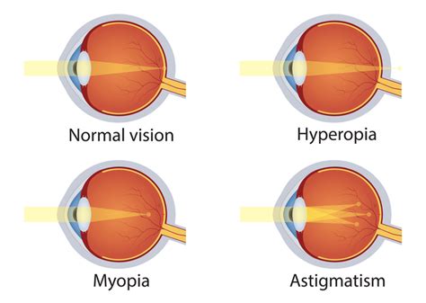 Myopia and astigmatism