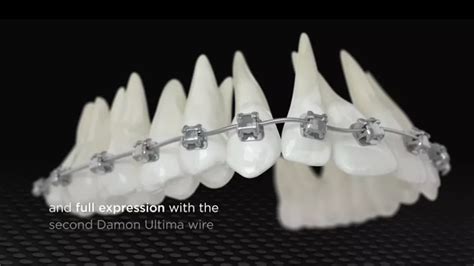 Damon Ultima System | Self-Ligation | Ormco Products | Orthodontic ...