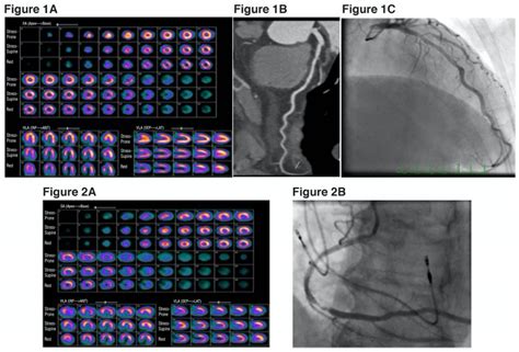 Myocardial Perfusion Scan Vs Stress Test at Horace Dickenson blog