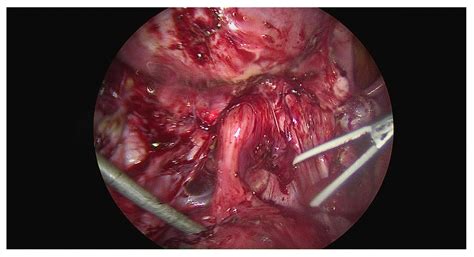 The Long-term Rate of Repeat Surgery After Optimal Excision Surgery of ...