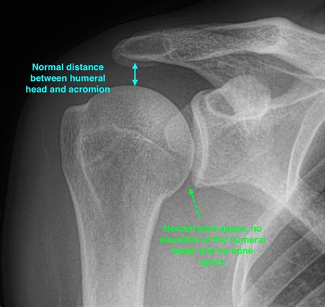 Shoulder Pain X Ray Normal at Tasha Hyman blog