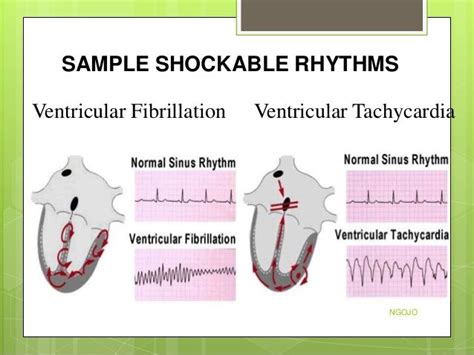 Shockable rhythms | Medical studies, Education, Nurse