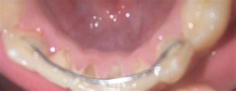 Image result for Retainer Problems