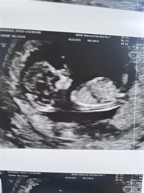 11 Week Ultrasound Pictures Boy