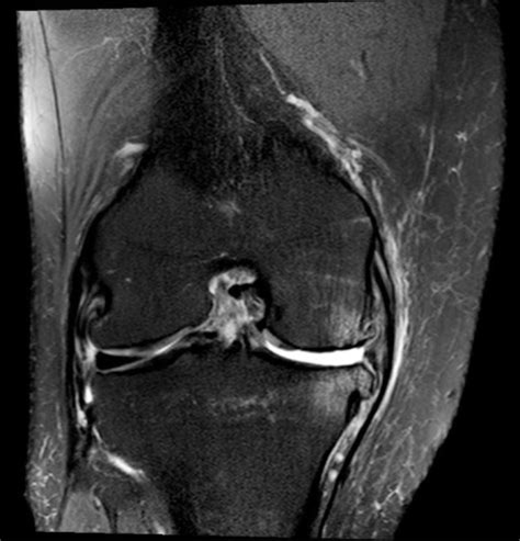 Coronal T2 weighted MRI image of a knee with a chronicA | Open-i