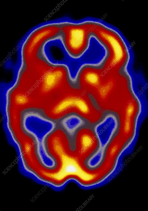 Image result for SPECT Scan Brain Prefrontal Cortex