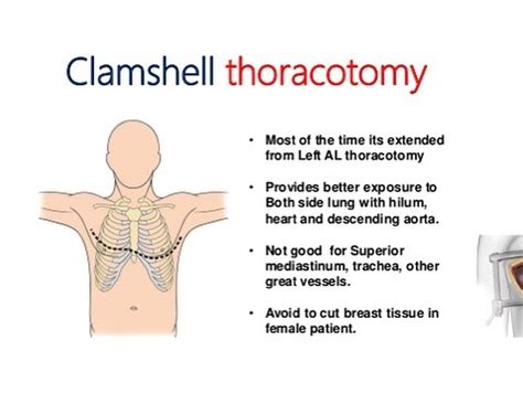 Image result for Clamshell Thoracotomy