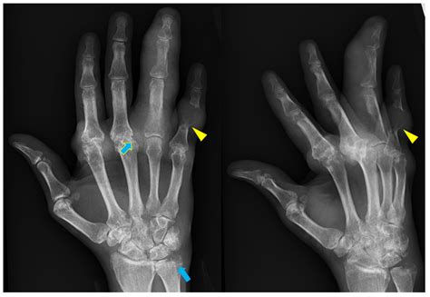 Osteoarthritis Hands X Ray at Glen Williams blog