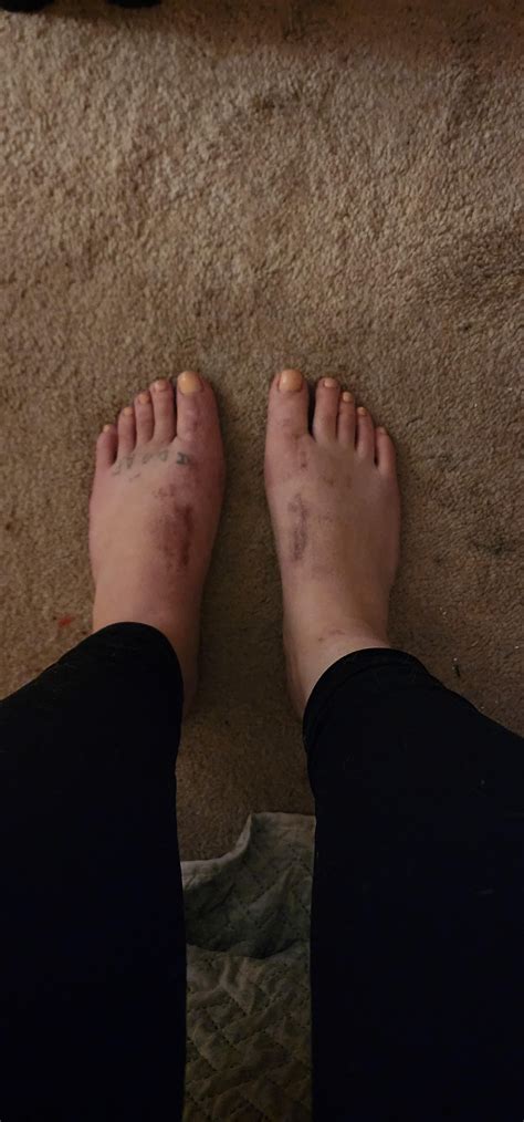 9 weeks post op : r/bunions