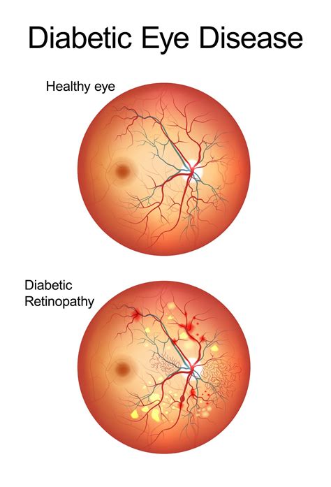 Diabetic Retinopathy Stages - Nashville, TN - Dr. Walter Choate