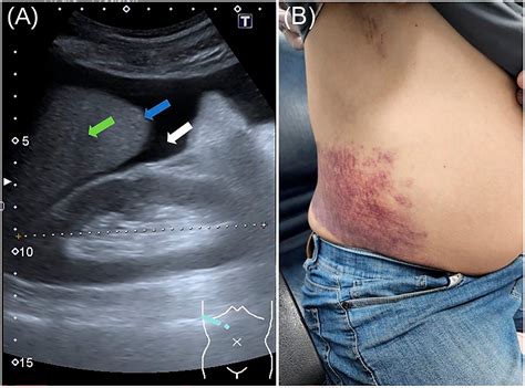 Spontaneous regression of Grey‐Turner sign in a patient with alcoholic ...