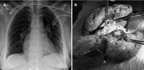 Single lung transplantation from a donor 8 months after double lung ...