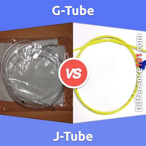 What Is The Difference Between A J-Tube And A G-Tube at JENENGE blog