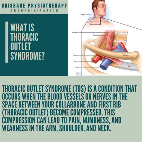 Thoracic Outlet Syndrome