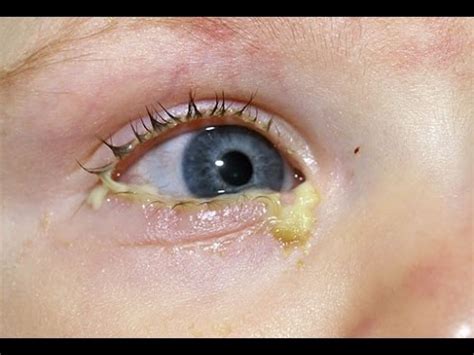 EEEWWYY EYE BOOGERS, CRUSTY EYES, EYE GUNK! - YouTube