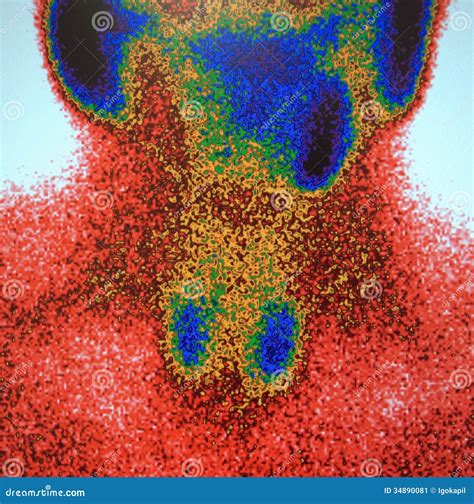 Salivary Glands ,nuclear Scan Stock Image - Image of blocked, fibroid: 34890081 - borders of parotid gland
