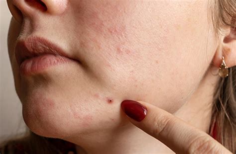 Fungal Acne vs Bacterial Acne: How to Spot the Difference – Dr. Su
