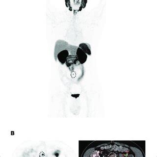 Prostate Cancer Recurrence 的图像结果