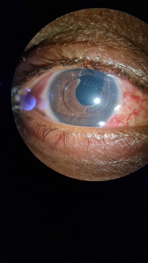 Hyphema Complications