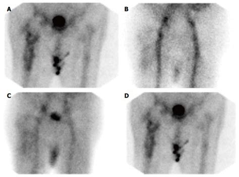 Imaging in Periprosthetic Joint Infection Diagnosis: A Comprehensive Review